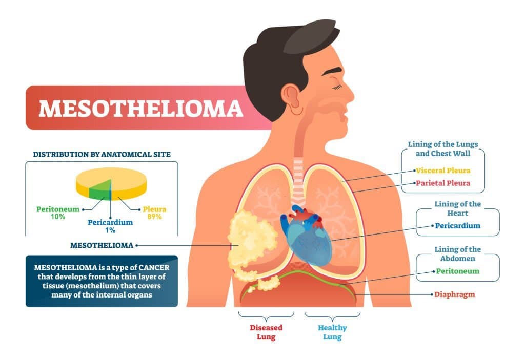 A diagram showing mesothelioma condition